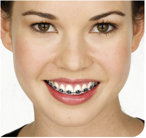 Although wearing braces can